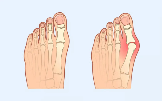 Schöne Schuhe für Hallux Valgus und anspruchsvolle Füße